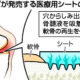 グンゼが再生医療に参入…膝の軟骨再生促すシートを開発、欧州で今月にも発売 : yomiDr. / ヨミドクター（読売新聞）