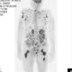 【どこまで分かる　その検査】がん発見に威力の全身ＭＲＩ「ＤＷＩＢＳ検査」　高性能化・高速撮像化で注目